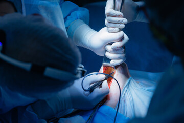 Surgical team performing complex operation umbilical hernia removal in hospital operating room