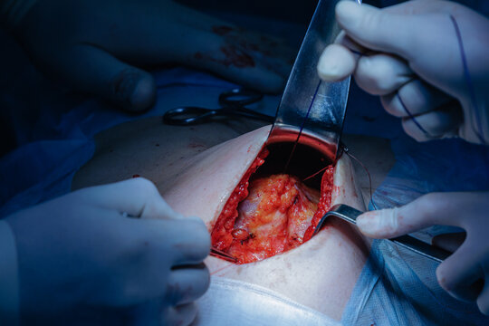 Surgical procedure: surgeons performing abdominal umbilical hernia surgery in operating room