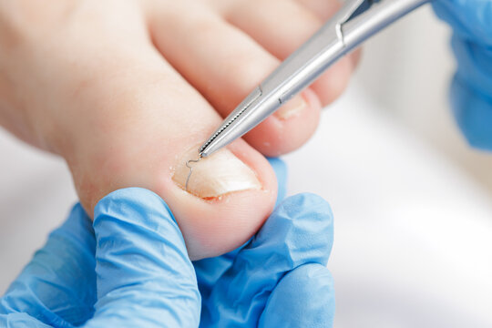 Closeup of podiatrist performing ingrown toenail treatment, white background