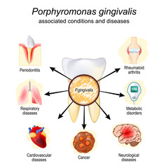Bacteria Porphyromonas gingivalis and associated conditions or diseases. vector 