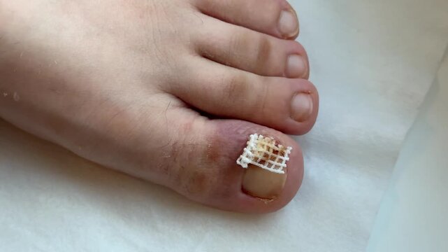 Closeup Bleeding Toenail With Mesh Dressing, Clinic FollowUp After Partial Nail Avulsion Showing Gauze And Adhesive, Scab And Crust Formation, Careful Wound Care In Sterile Setting, Patient