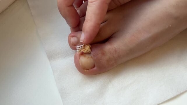 Closeup Bleeding Toenail With Mesh Dressing, Clinic FollowUp After Partial Nail Avulsion Showing Gauze And Adhesive, Scab And Crust Formation, Careful Wound Care In Sterile Setting, Patient