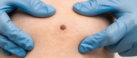 Dermatologist Examining Suspicious Mole During Professional Skin Cancer Screening with Protective Gloves