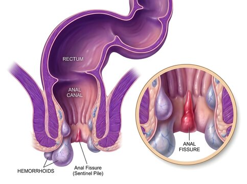 Labeled Medical Illustration of Hemorrhoids and Anal Fissure &ndash; Human Rectal Anatomy Diagram for Clinical Education