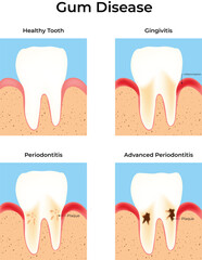 Stages of Gum Disease Progression From Healthy to Advanced Periodontitis Vector Illustration