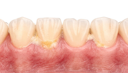 Isolated closeup image of interdental spaces with visible soft plaque buildup near gums emphasizing oral hygiene challenges on a plain white backdrop.