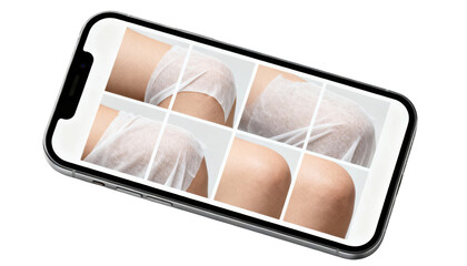 Minimalist smartphone screen showing anonymized progress photos of a covered skin area in a grid layout isolated on a clean white background.