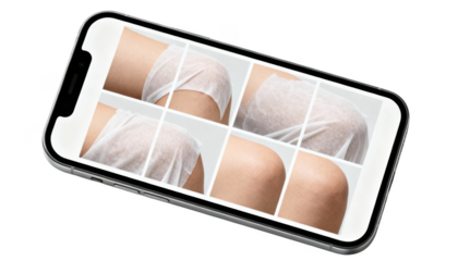 Minimalist smartphone screen showing anonymized progress photos of a covered skin area in a grid layout isolated on a clean white background.