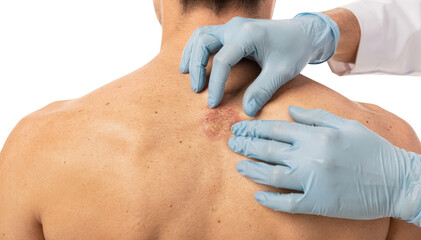 Dermatologist wearing gloves closely examines a small plaque on a seated patients upper back focusing on skin texture and discoloration detail against a white background.