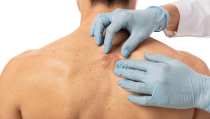 Dermatologist wearing gloves closely examines a small plaque on a seated patients upper back focusing on skin texture and discoloration detail against a white background.