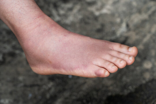 Swollen Foot After Cast Removal of Metatarsal Fracture