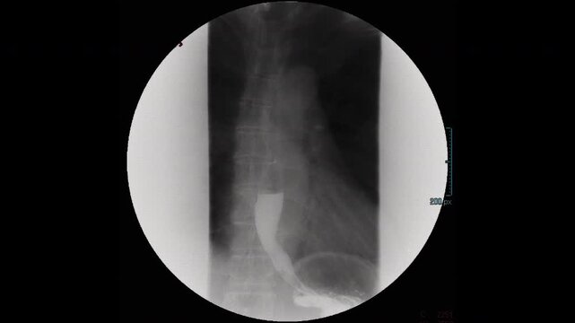 Barium swallow X-ray is used to detect abnormalities in the upper gastrointestinal tract and stomach.