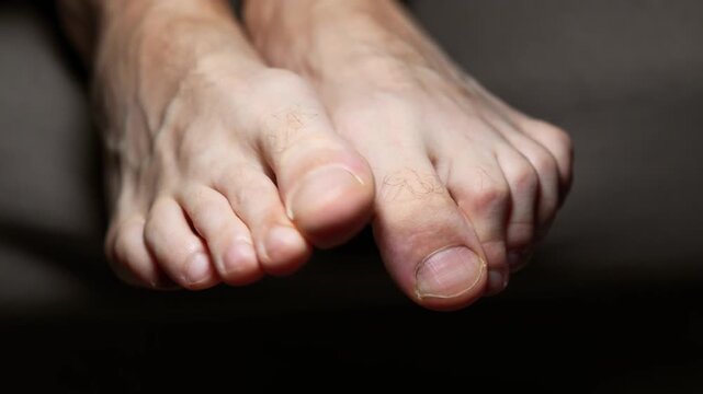 A close-up of a man's bare foot.
A man's toes.
A close-up of a man's bare foot in a dark room.
A man wiggling his toes.
Itchy skin on his feet.
Fungal infection on his feet.