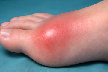 Photorealistic 3D clinical-style foot depiction, 45-degree angled view showing the big toe joint swelling consistent with gout flare, mild-to-moderate erythema
