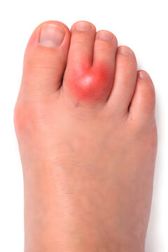 Photorealistic 3D clinical-style foot depiction, 45-degree angled view showing the big toe joint swelling consistent with gout flare, mild-to-moderate erythema