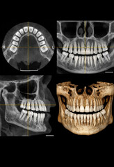Detailed dental CT scan showing axial, coronal, sagittal, and 3D views of jaw and teeth for diagnostic and treatment plan