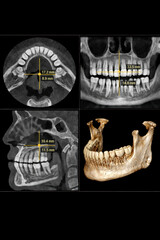 Detailed dental CT scan showing axial, coronal, sagittal, and 3D views of jaw and teeth for diagnostic and treatment plan