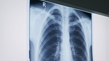 Closeup human lungs x-ray during diagnostic. Radiographic results in hospital