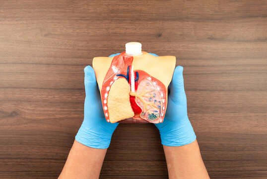 M&eacute;dico explicando la EPOC y la bronquitis cr&oacute;nica mediante un modelo anat&oacute;mico de alv&eacute;olos; neum&oacute;logo mostrando p&eacute;rdida de funci&oacute;n pulmonar y obstrucci&oacute;n respiratoria. Primer plano.