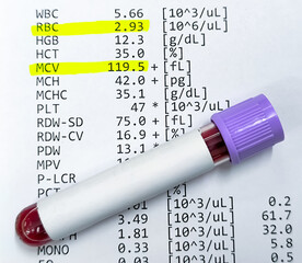 Hematological report: Low RBC and High MCV, Suggestive of Pernicious anemia or Alcoholic liver disease or Bone marrow disease.