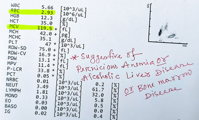 Hematological report: Low RBC and High MCV, Suggestive of Pernicious anemia or Alcoholic liver disease or Bone marrow disease.
