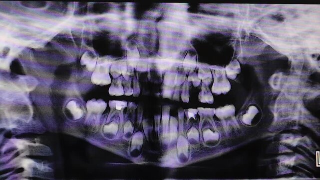 Dentist reviews a panoramic dental X-ray of a 9-year-old child, illustrating tooth development, primary and permanent teeth and a hidden developing wisdom tooth embedded in the jaw bone. For dentistry