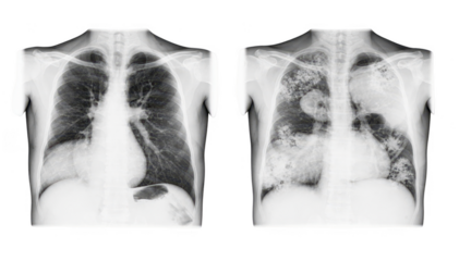 Clear sidebyside chest Xrays on a white background showing healthy lungs contrasted with suspicious shadow areas highlighting differences in lung clarity and opacity.