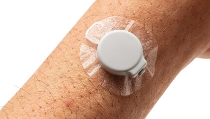 Closeup of a continuous glucose monitor patch adhered to the upper arm highlighting skin texture and sensor details on a clean white background.