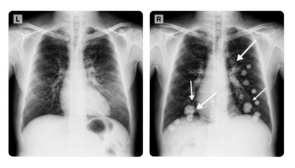 Grayscale sidebyside images of chest Xrays displaying normal lung fields on one side and abnormal spots with arrows indicating questionable shadow regions on the opposite side.