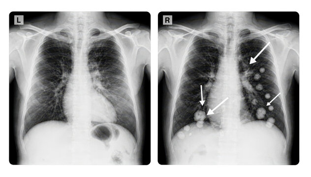 Grayscale sidebyside images of chest Xrays displaying normal lung fields on one side and abnormal spots with arrows indicating questionable shadow regions on the opposite side.