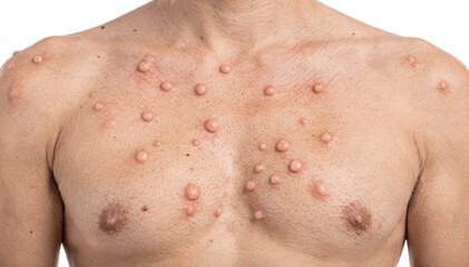 Naklejka premium Closeup of a neutral torso displaying multiple papules over the chest area on a white background highlighting anterior distribution of skin lesions.