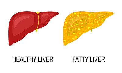 Healthy liver and Fatty liver icon, Comparison of healthy liver and fatty liver disease. Flat vector illustration design.