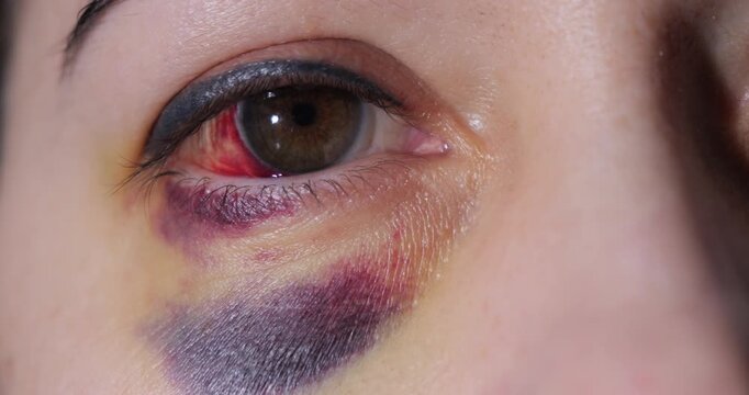 Eye injury. Hemorrhage in the eye. Bruise on the face under the eye. Examination by a doctor.