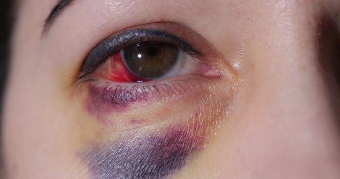 Eye injury. Hemorrhage in the eye. Bruise on the face under the eye. Examination by a doctor.