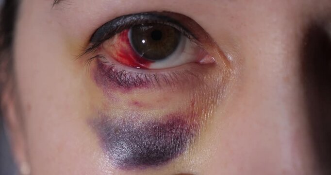 Eye injury. Hemorrhage in the eye. Bruise on the face under the eye. Examination by a doctor.