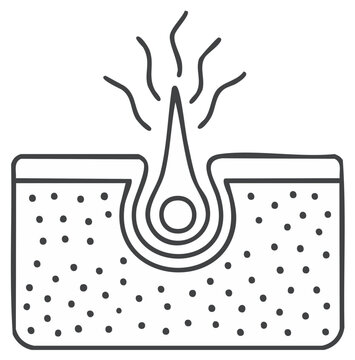 Diagram of Blackhead in Skin Pore. Acne Cause. Dermatology and Skin Care Concept Illustration. Vector.