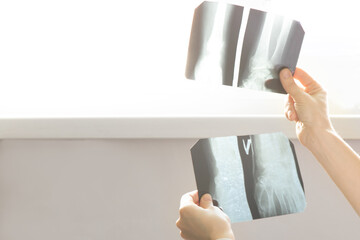 A doctor holds and examines X-rays of a fractured arm on a light screen. Medical diagnosis of injury, bone monitoring