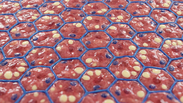 NASH Liver Spheroid: Chicken Wire Fibrosis Encasing Steatotic Hepatocytes (3D Organoid Model)