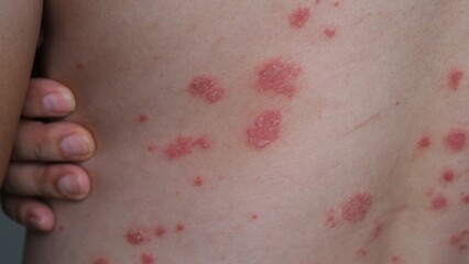 Fototapeta premium A man with his Psoriasis on his back.