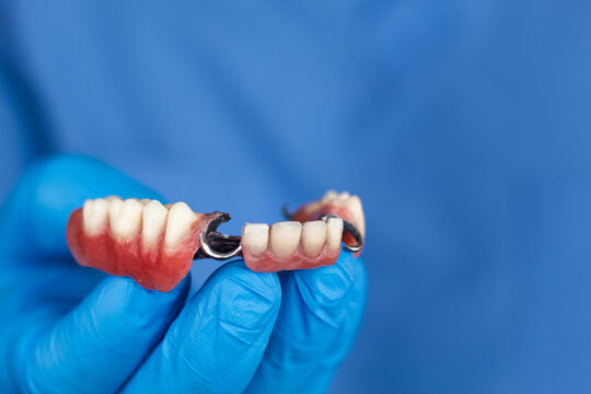 Dentist holds a removable partial denture made of cobalt-chromium. Concept of dental health, oral rehabilitation, modern dentistry, clinical use, treatment, stomatology, and professional tooth replace