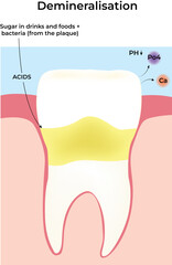 Tooth Demineralisation Process Explained vector illustration