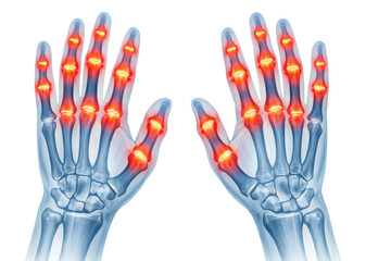 Human hand skeleton anatomy showing finger joint inflammation arthritis pain medical illustration bilateral hands isolated on white background