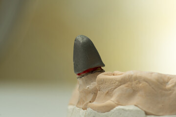 Frames of ceramic-metal  crowns on the stand of the articulator