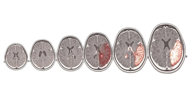 Illustrated cardiac MRI shortaxis slices displaying detailed tissue characterization with marked dilation and late gadolinium enhancement regions on a crisp white background.