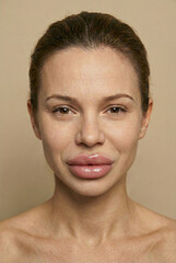 woman with huge unnatural filled lips, cosmetic filler 