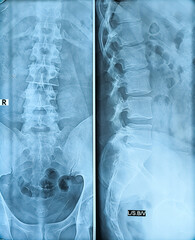 X-ray lumber spine showing muscle spasm, mild scoliosis having leftward convexity is noted.