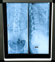 X-ray lumber spine showing muscle spasm, mild scoliosis having leftward convexity is noted.