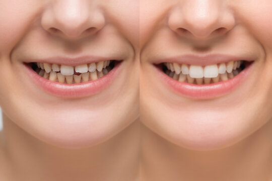 Collage of woman with diastema between upper front teeth before after treatment,showing big gap crack,older middle aged female needs stomatology dentist,medicine healthcare close up. 
