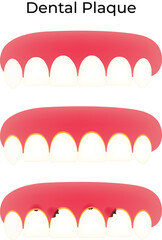 Dental Plaque and Tooth Decay Progression