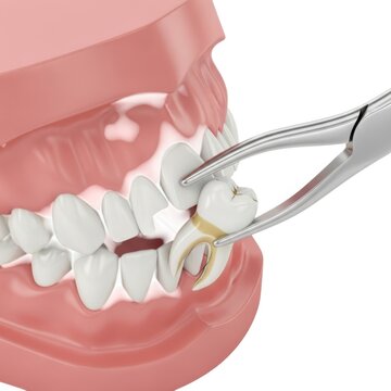 Dental model showing tooth extraction process with forceps